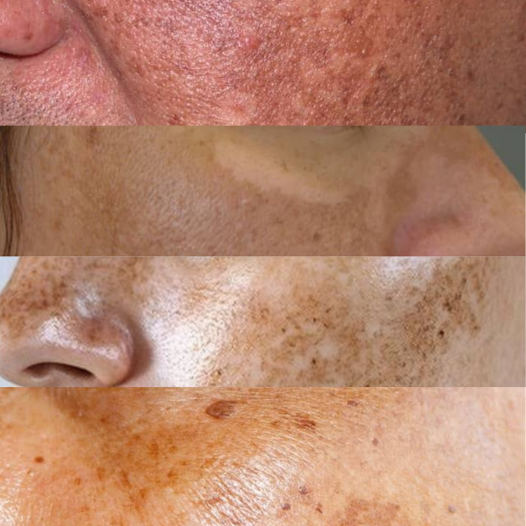 Pigmentation