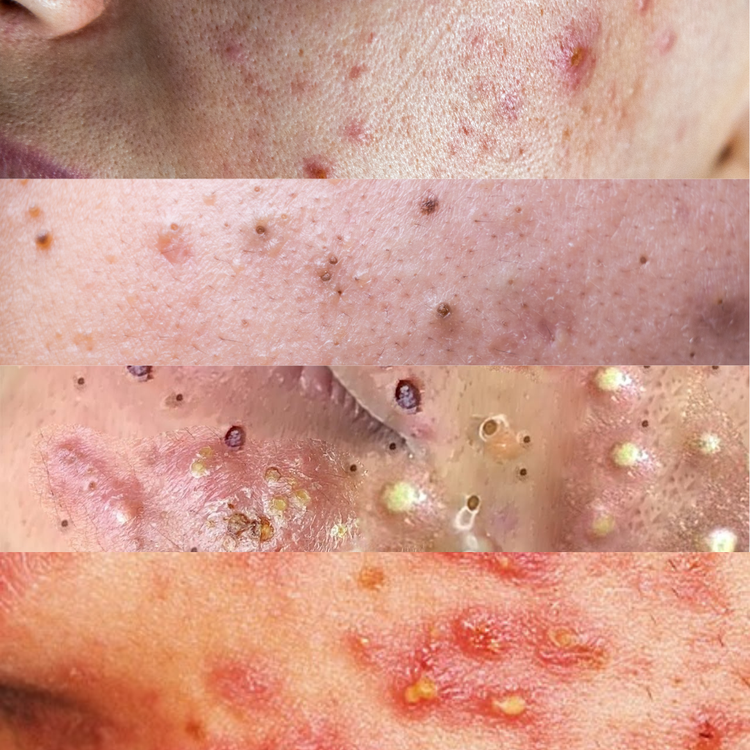 Pimples