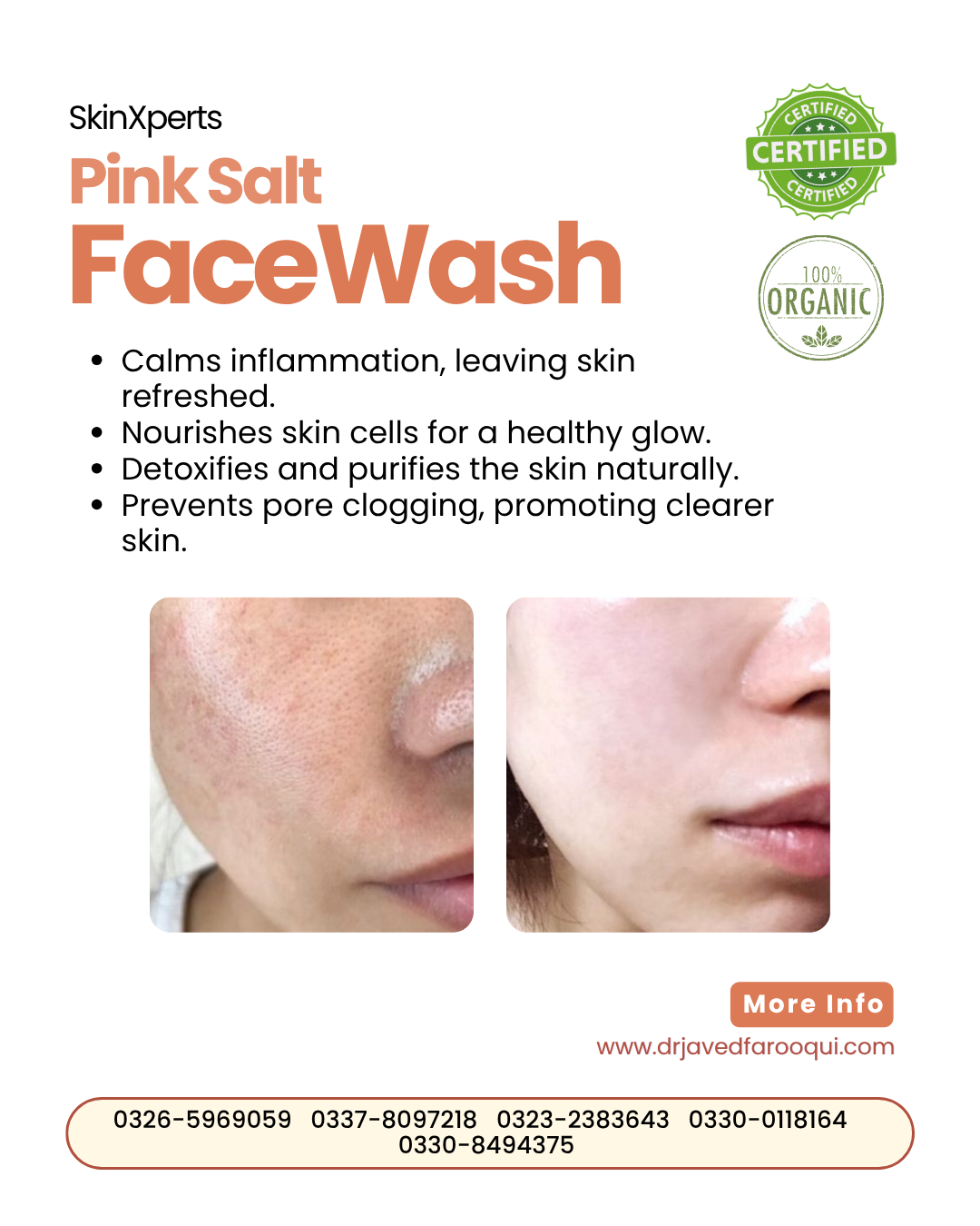 Bride Radiance Box – Pimple Care