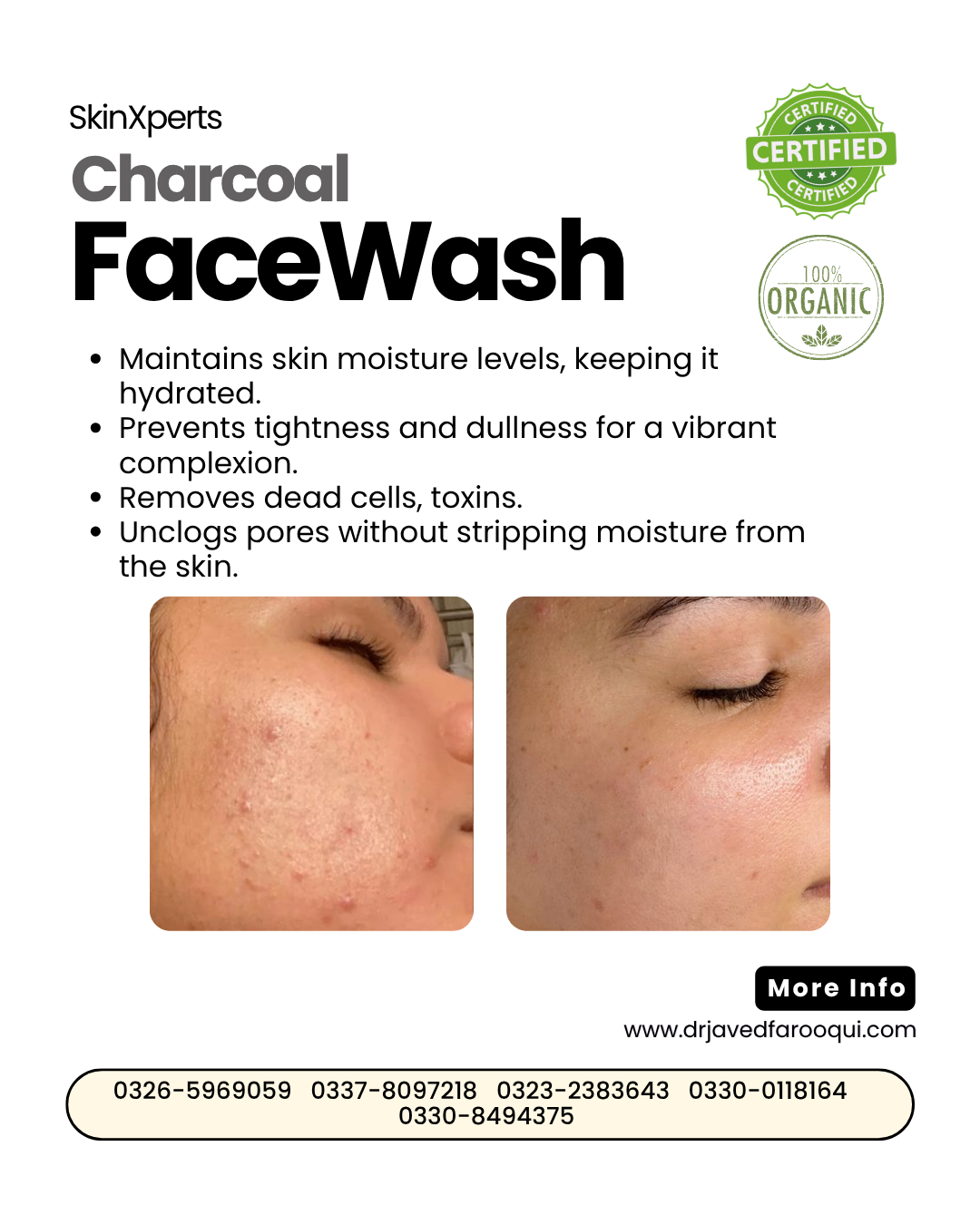 Bride Radiance Box – Pimple Care