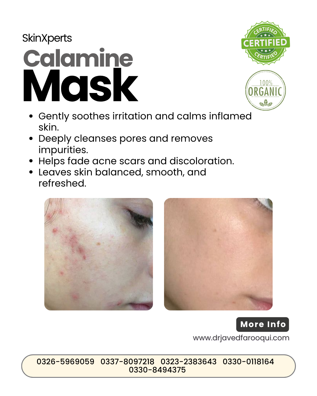Bride Radiance Box – Pimple Care
