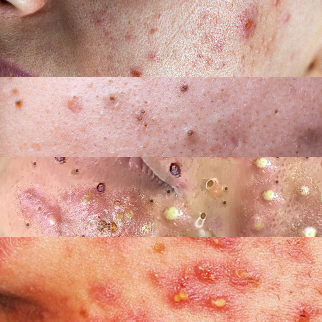 Pimples