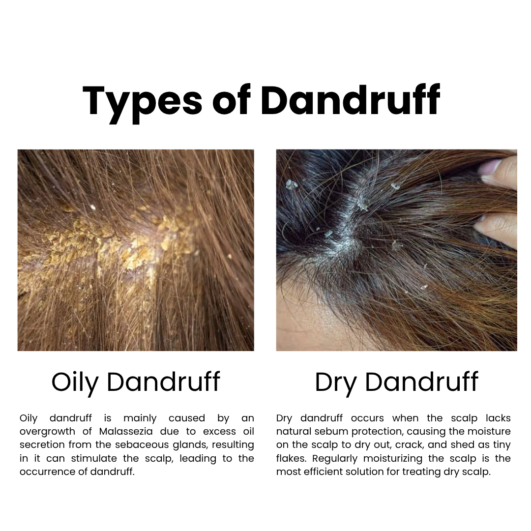 Dandruff