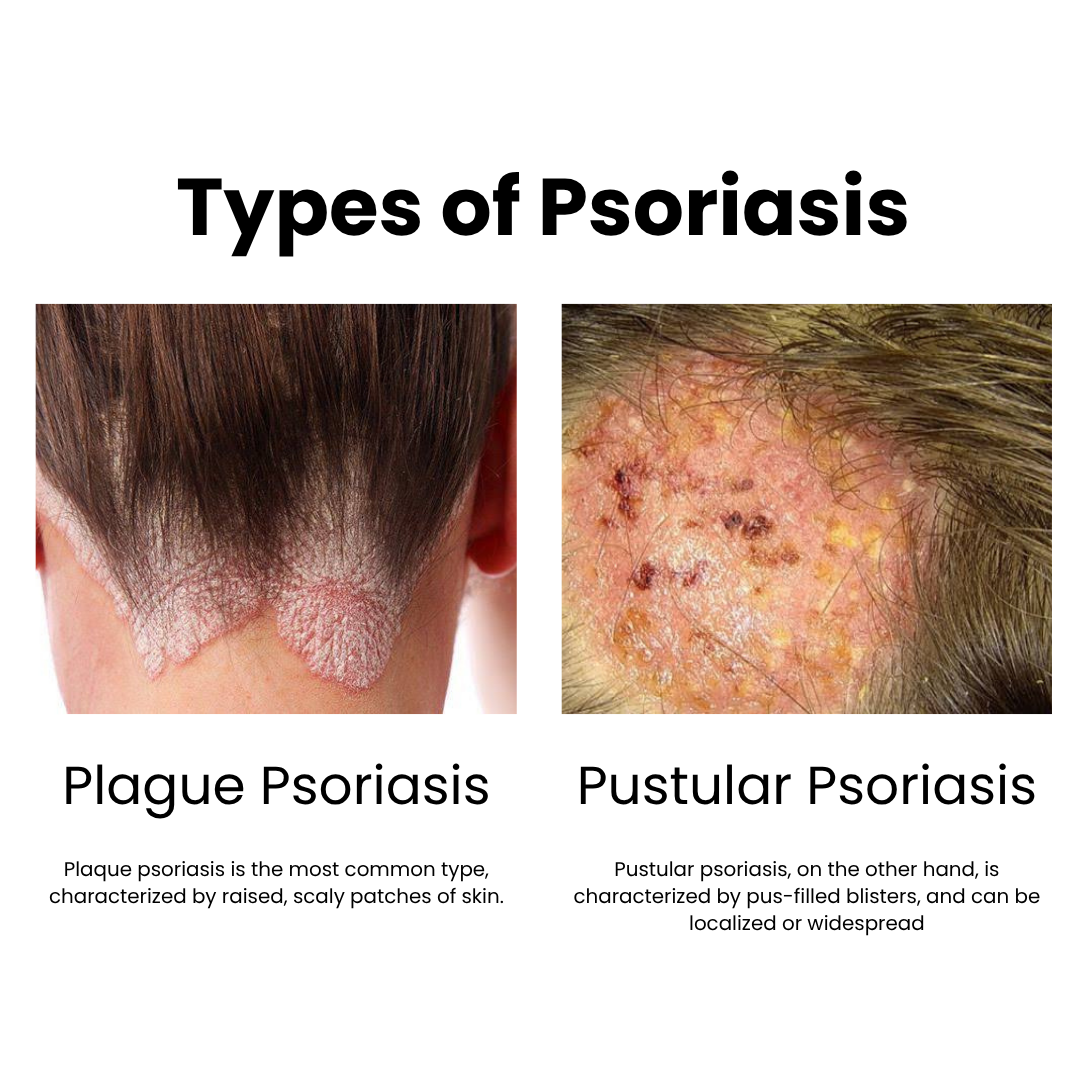 Psoriasis
