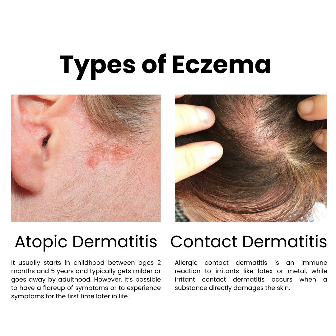 Eczema